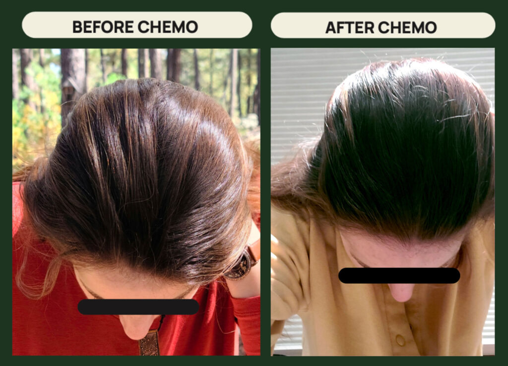 hair before and after chemo. Scalp Cooling for Chemo testimonia